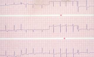 Sudden Cardiac Death/Ventricular Arrhythmia Risk in Atrial Fibrillation